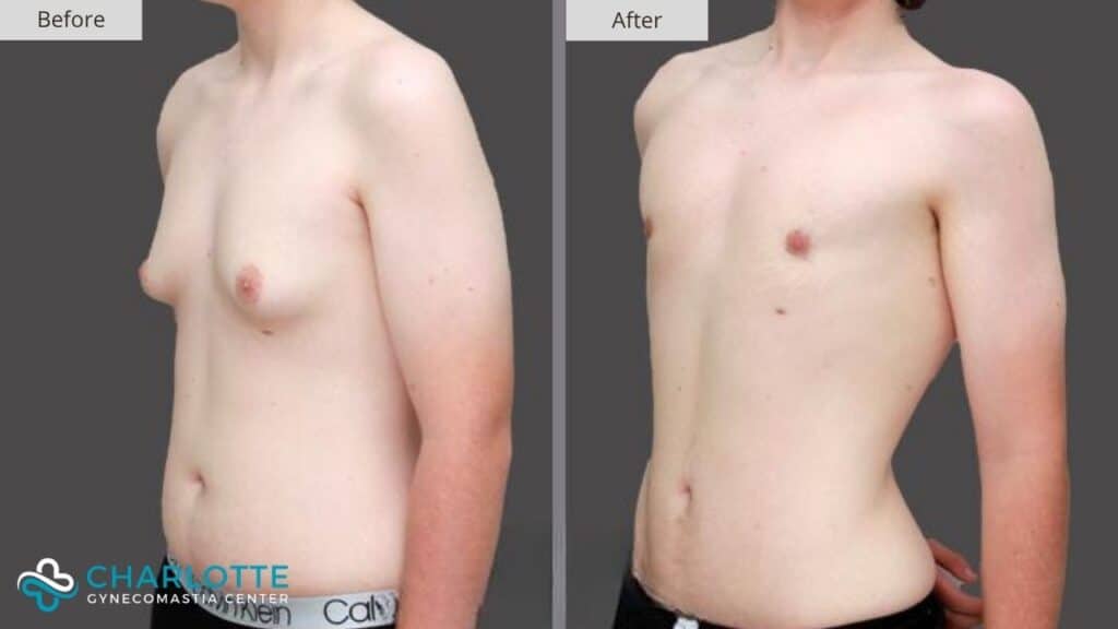 Charlotte Gynecomastia Before and After Adolescent