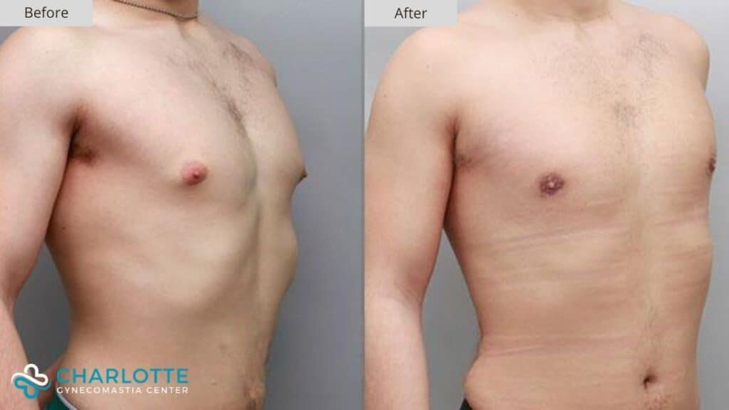 Charlotte Gynecomastia Before and After Adolescent Gyno