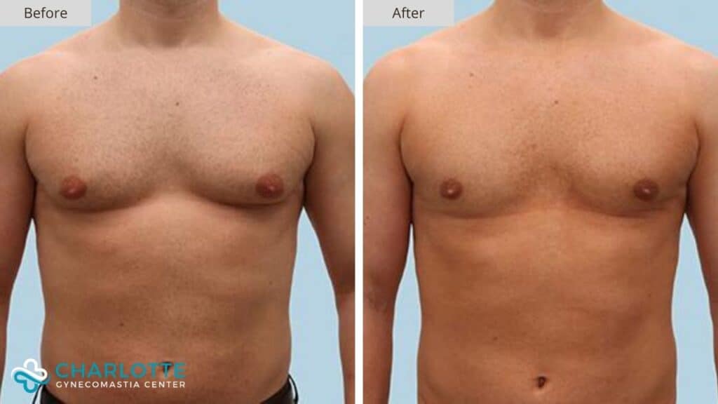 Charlotte Gynecomastia Before and After Adult