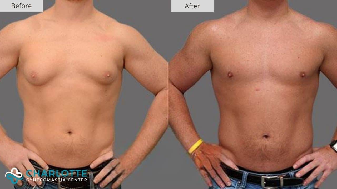Charlotte Gynecomastia Before and After Adult Male