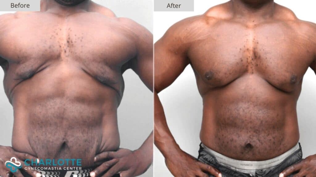 Charlotte Gynecomastia Before and After Bodybuilder Frame