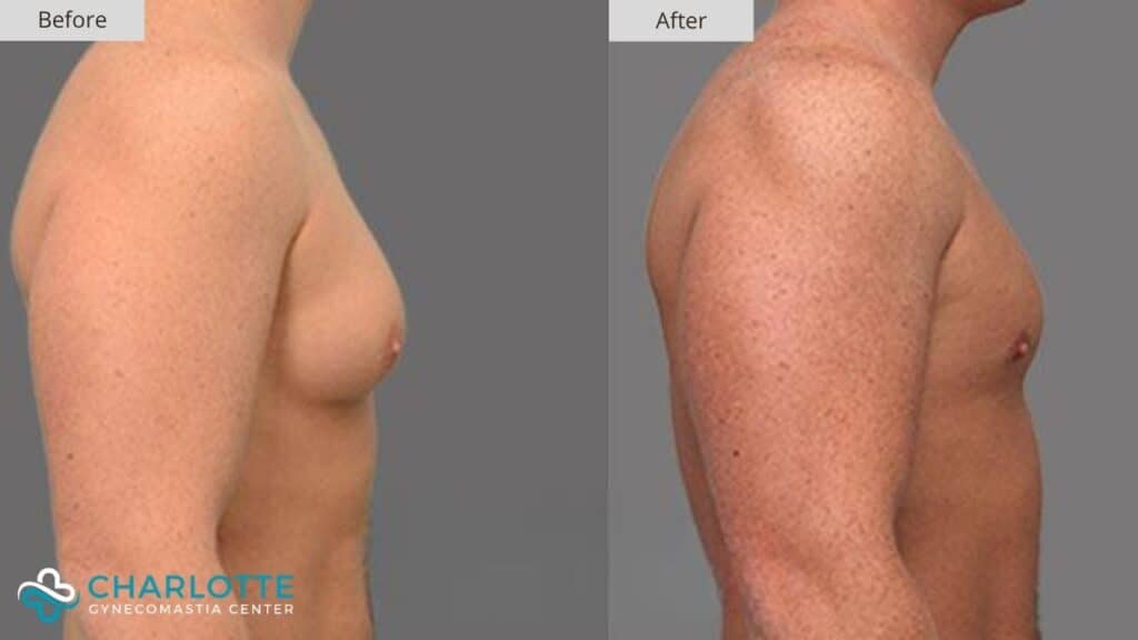 Charlotte Gynecomastia Before and After Bodybuilder Gyno