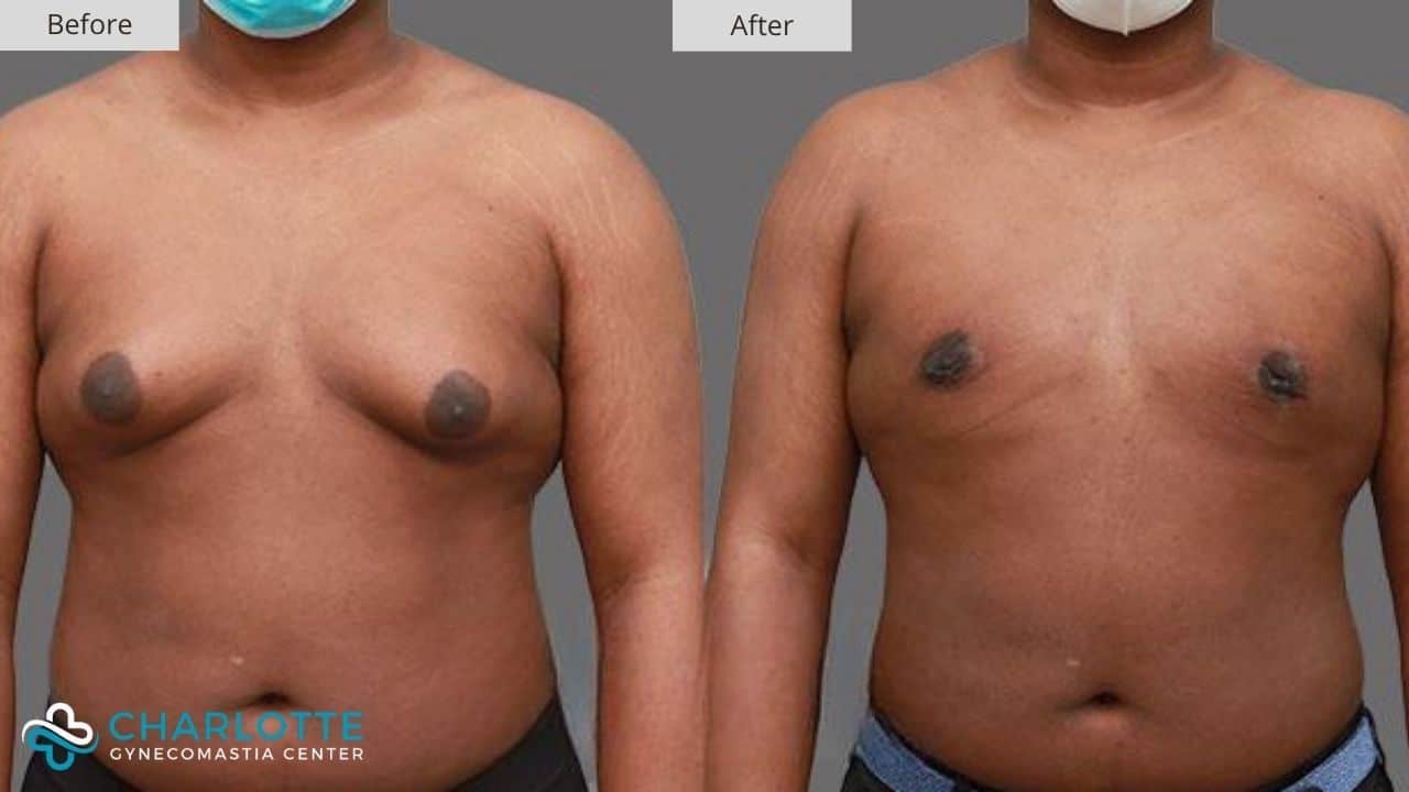 Charlotte Gynecomastia Before and After Candidate