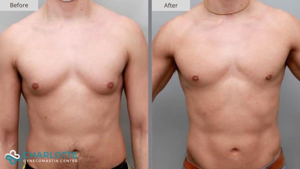 Charlotte Gynecomastia Before and After Grade 1