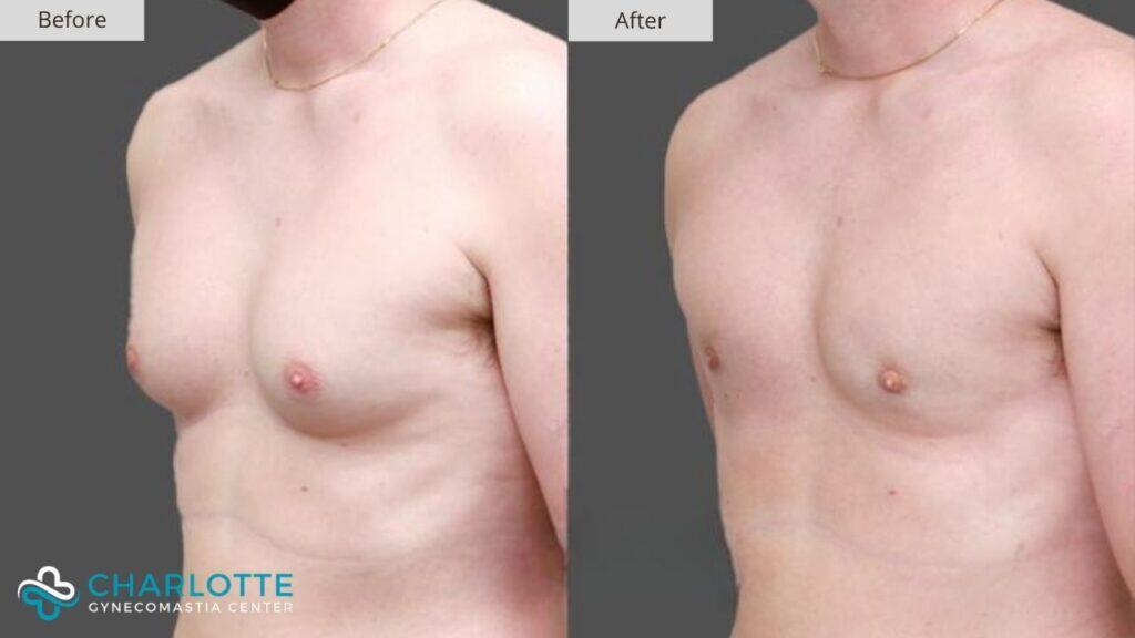 Charlotte Gynecomastia Before and After Grade 1 Gyno