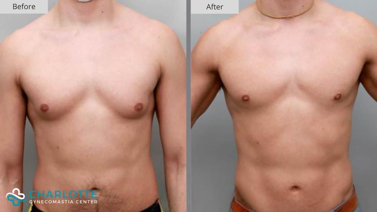 Charlotte Gynecomastia Before and After Grade 1