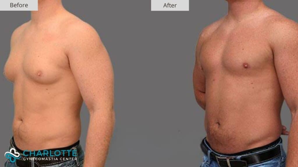 Charlotte Gynecomastia Before and After Grade 2 Gynecomastia