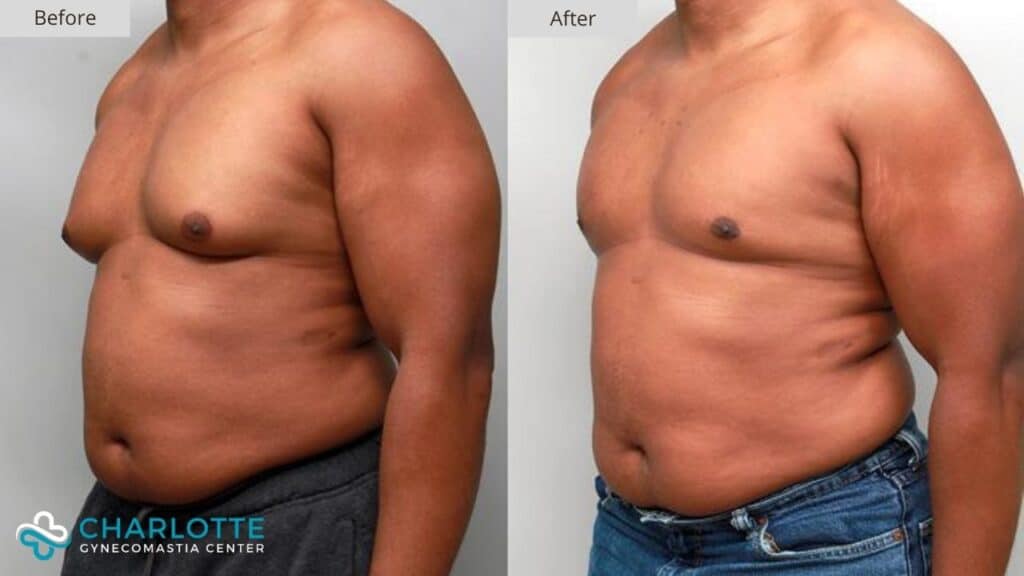 Charlotte Gynecomastia Before and After Grade 3
