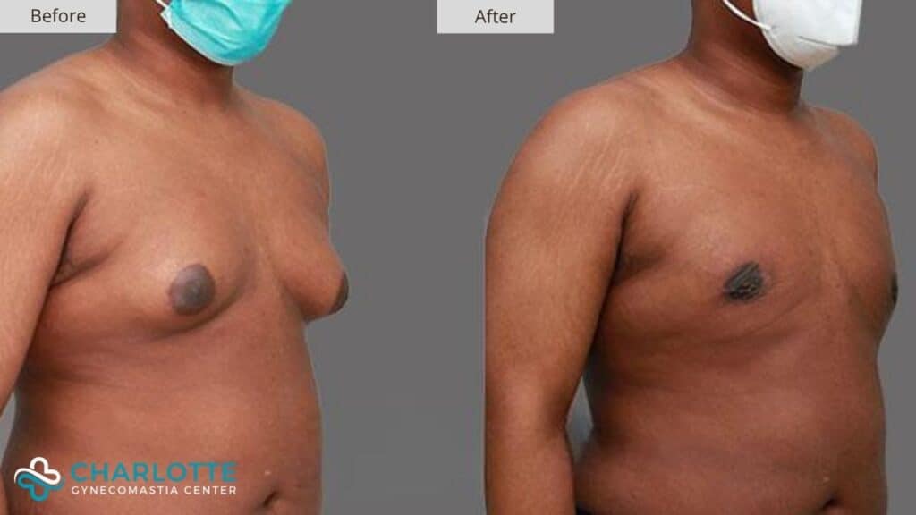 Charlotte Gynecomastia Before and After Grade 3 Male Breast Reduction