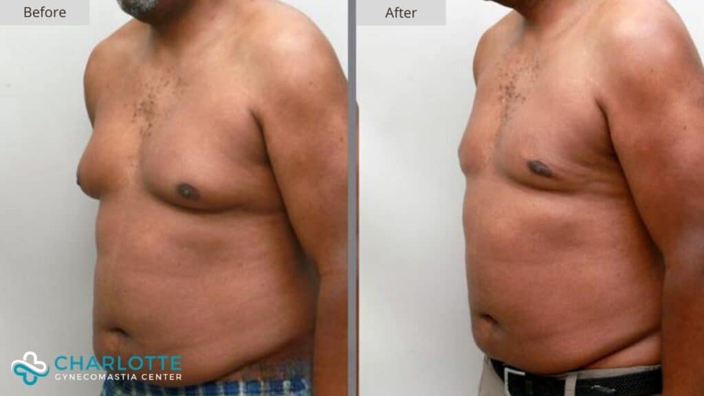 Charlotte Gynecomastia Before and After Senior Gynecomastia