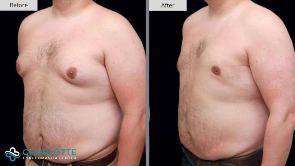 Charlotte Gynecomastia Before and After Stage 2