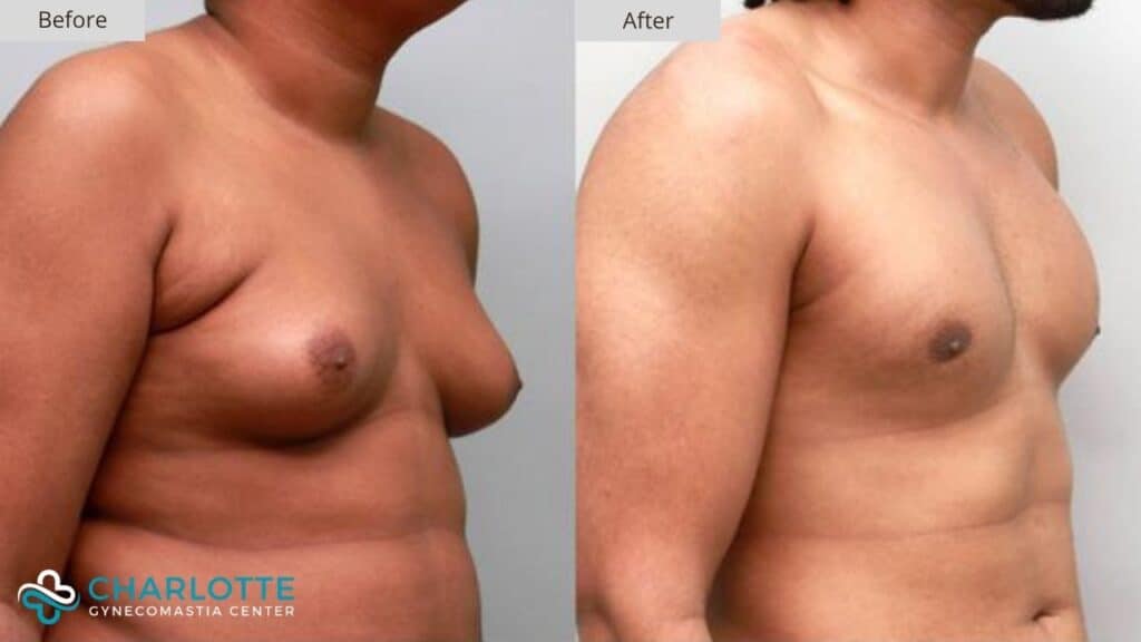Charlotte Gynecomastia Before and After Stage 3