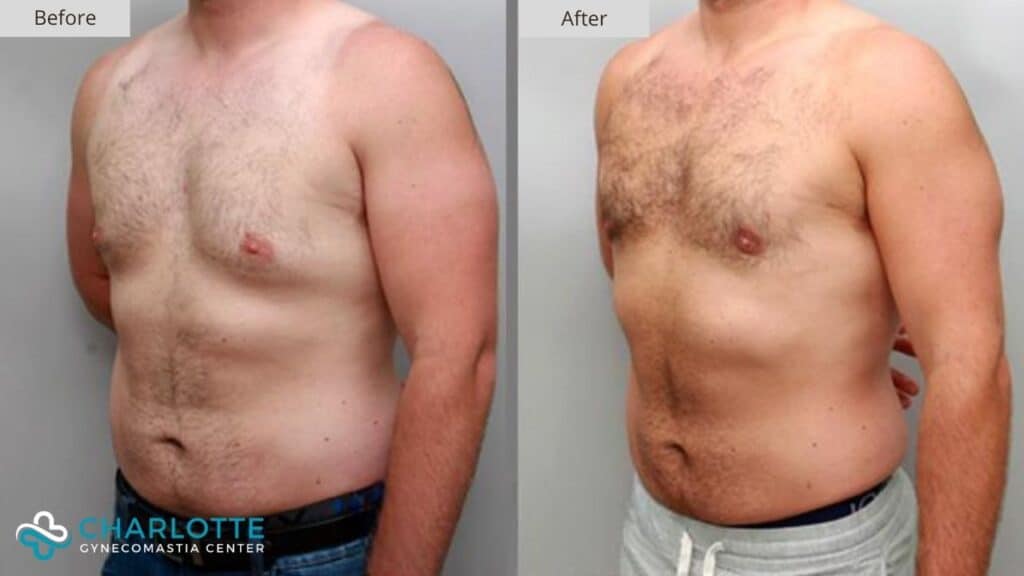 Charlotte Gynecomastia Before and After Surgery