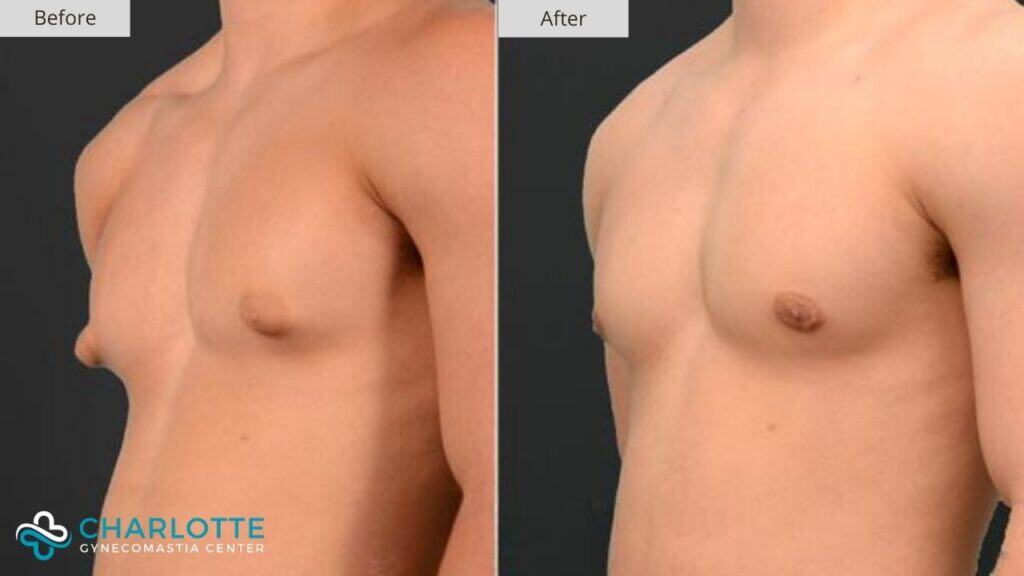 Charlotte Gynecomastia Before and After Teenager