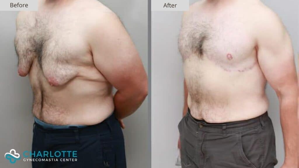 Charlotte Gynecomastia Before and After Weight Loss