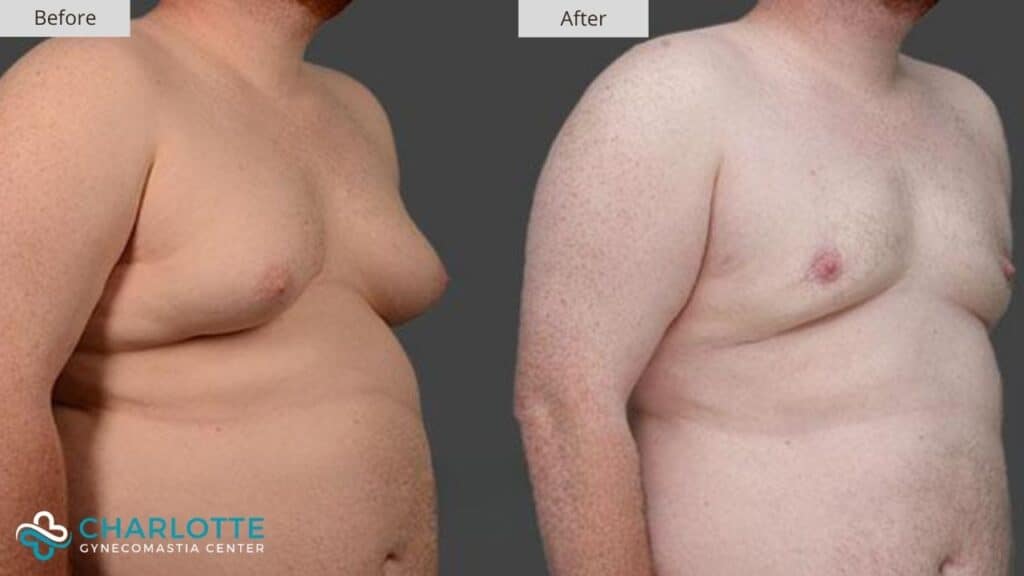Before and after photos of a man's chest before and after surgery.