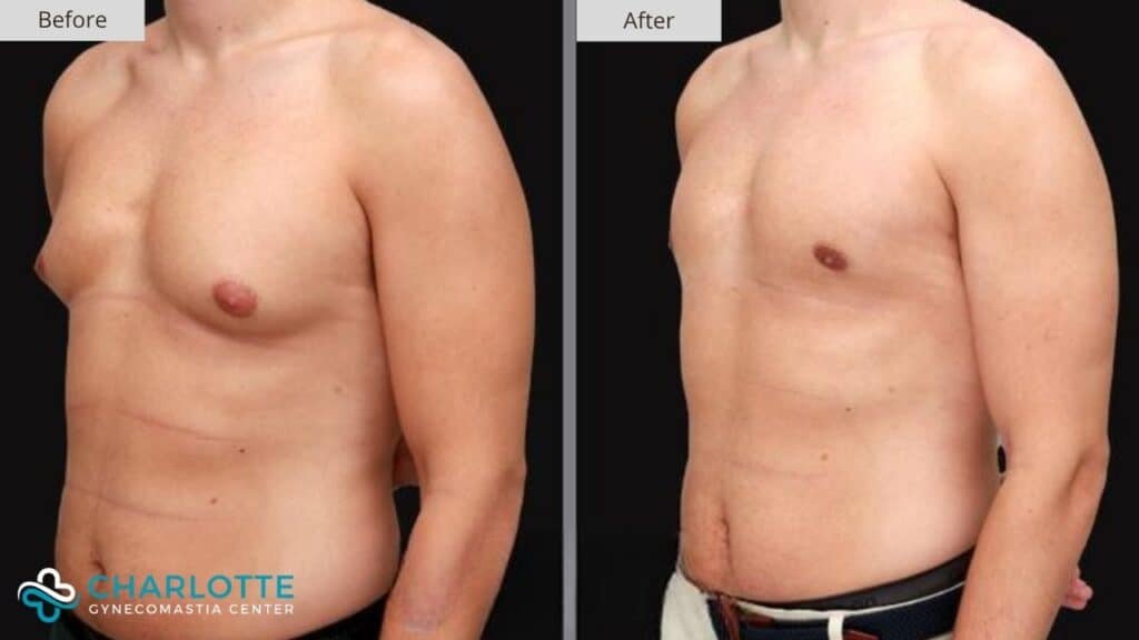 Charlotte Gynecomastia Results