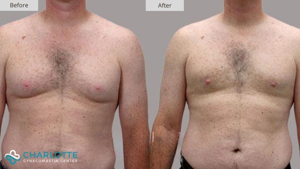 Charlotte Pseudogynecomastia Before and After