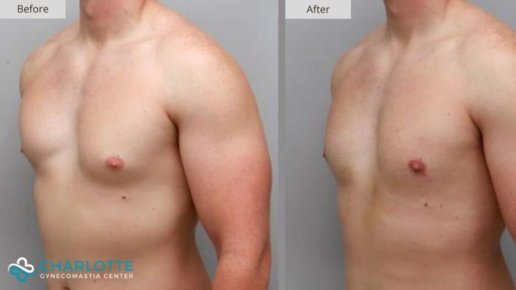 Gynecomastia Frequently Asked Questions
