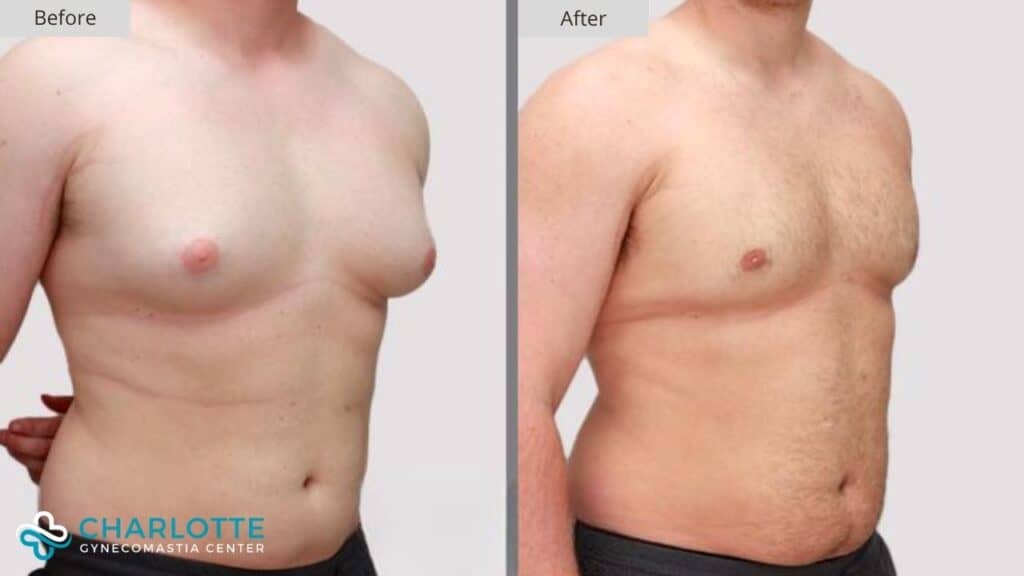 Before and after photos of a man's chest before and after surgery.