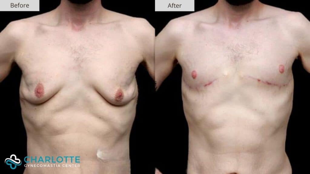 Charlotte Gynecomastia Before and After Patient 104a