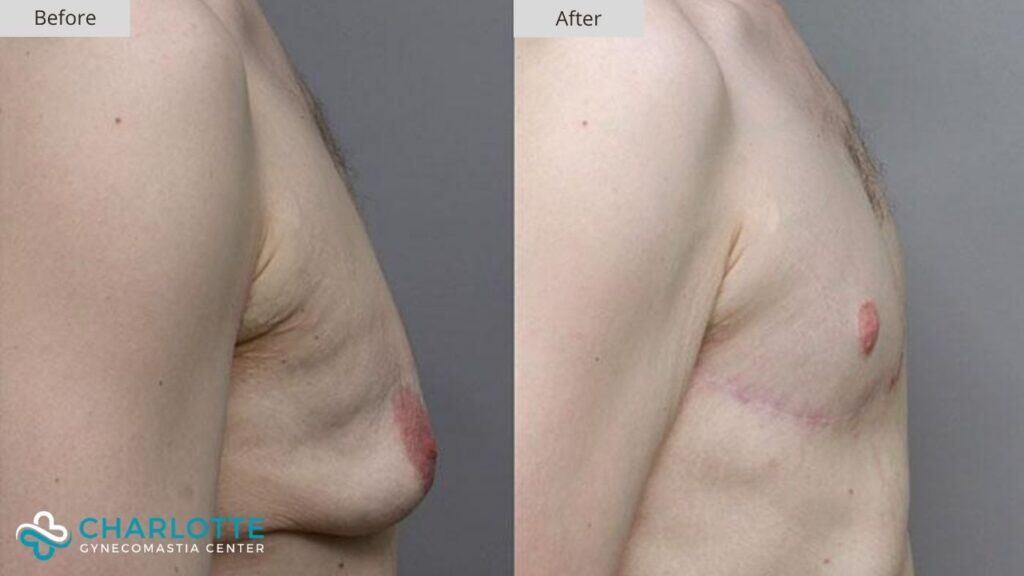 Charlotte Gynecomastia Before and After Patient 104b