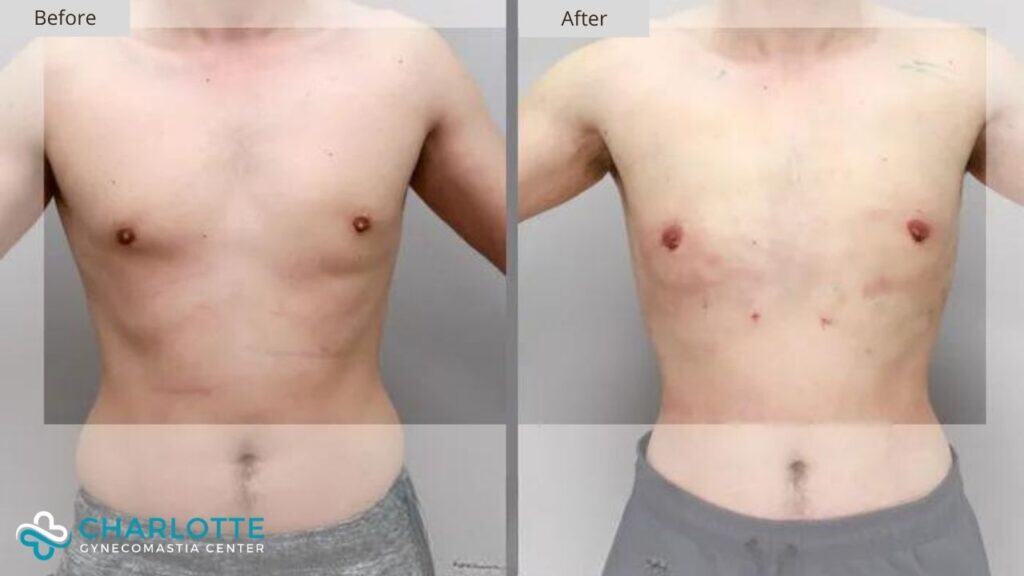 Charlotte Gynecomastia Before and After Patient 105a