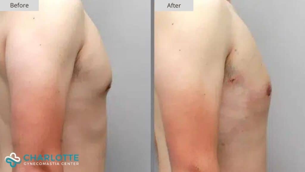 Charlotte Gynecomastia Before and After Patient 105b