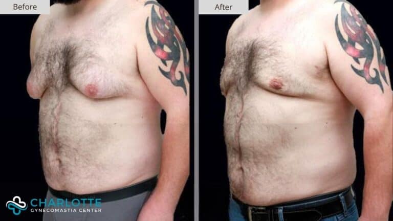 Charlotte Gynecomastia Before and After Patient 109a