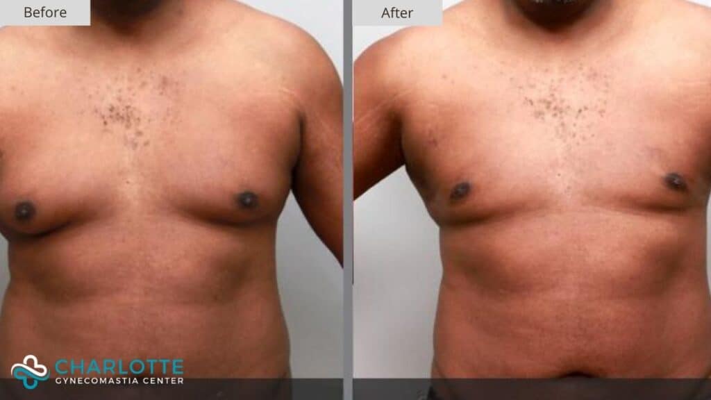 Charlotte Gynecomastia Before and After Patient 110b