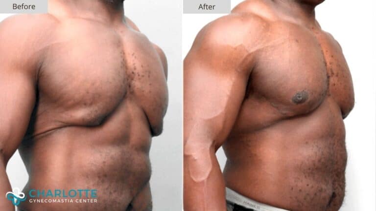 Charlotte Gynecomastia Before and After Patient 113a