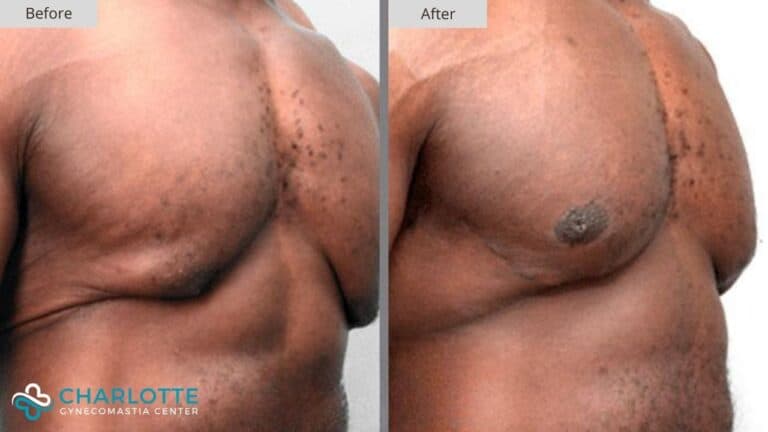 Charlotte Gynecomastia Before and After Patient 113c