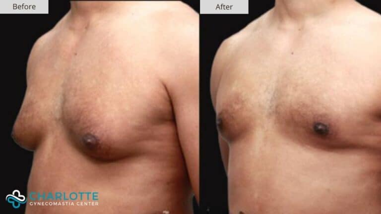 Charlotte Gynecomastia Before and After Patient 116a