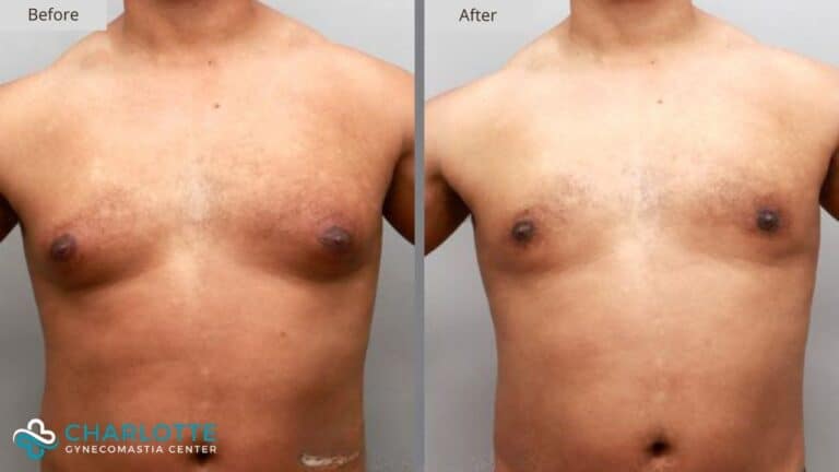 Charlotte Gynecomastia Before and After Patient 116b