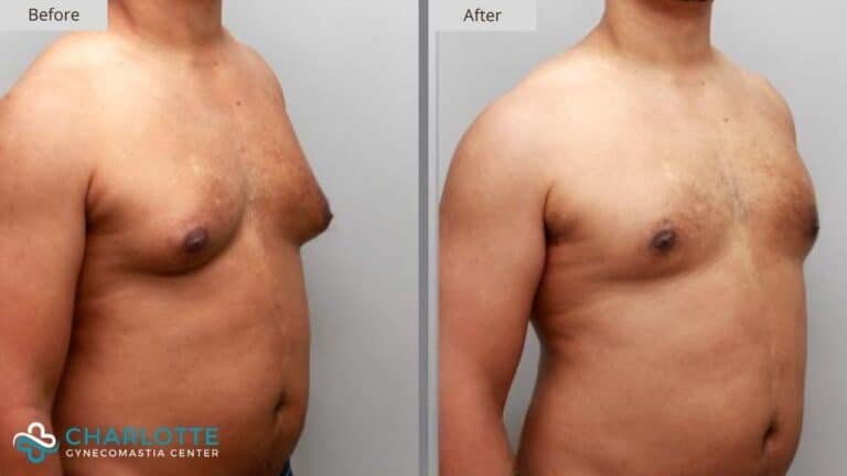 Charlotte Gynecomastia Before and After Patient 116c