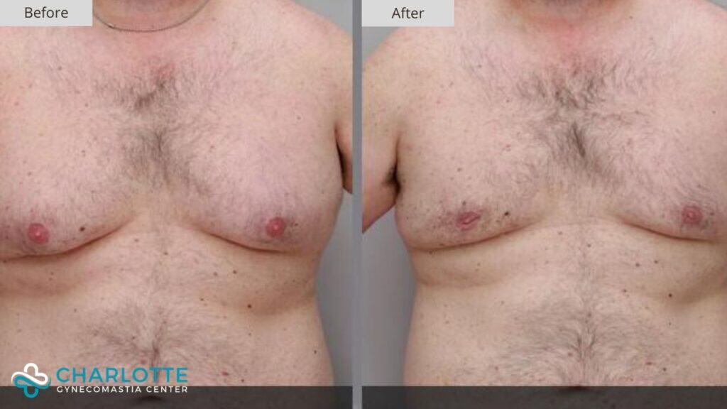 Charlotte Gynecomastia Before and After Patient 117a