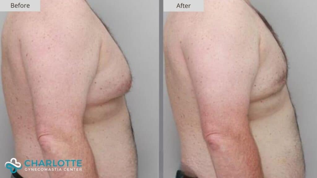 Charlotte Gynecomastia Before and After Patient 117b