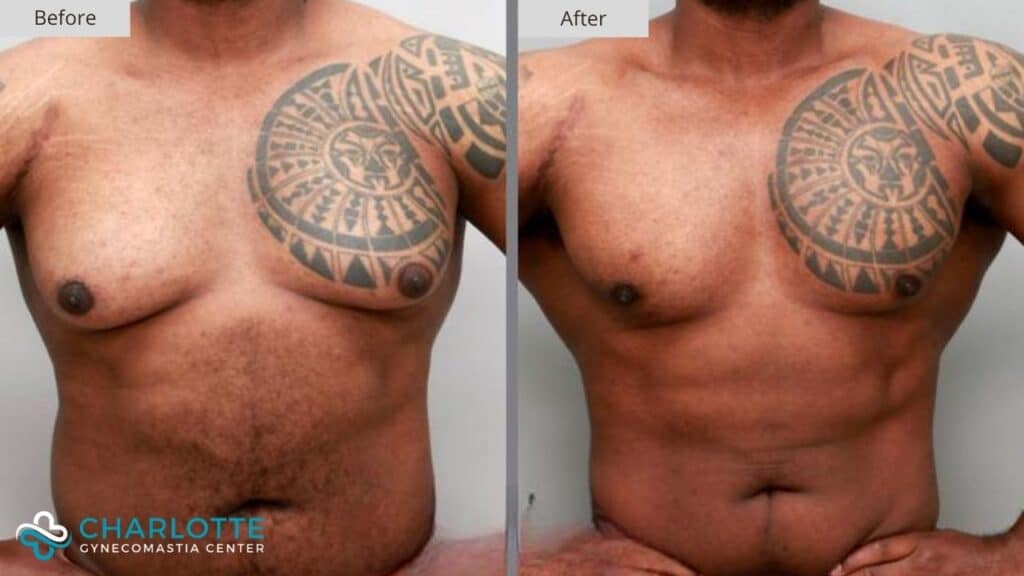 Charlotte Gynecomastia Before and After Patient 123a