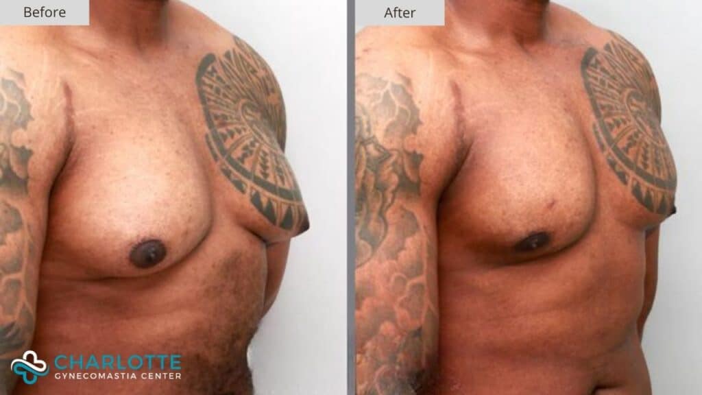 Charlotte Gynecomastia Before and After Patient 123b