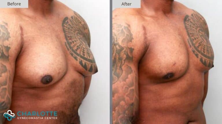 Charlotte Gynecomastia Before and After Patient 123b
