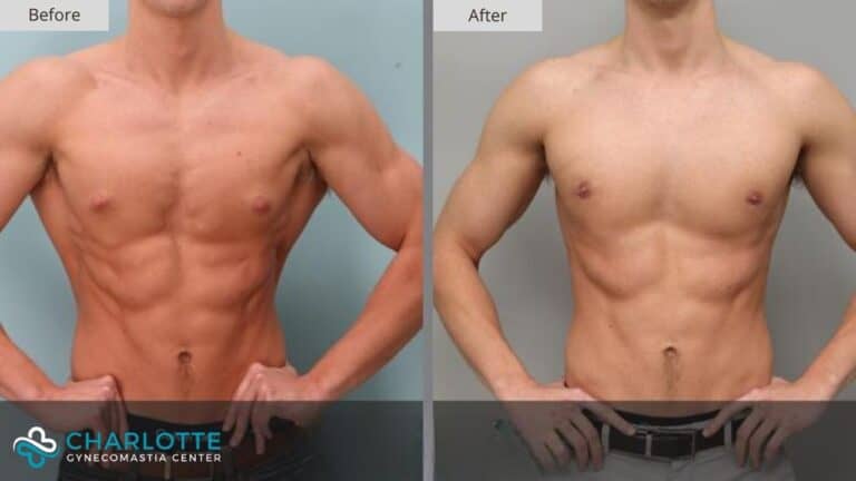 Charlotte Gynecomastia Before and After Patient 124a