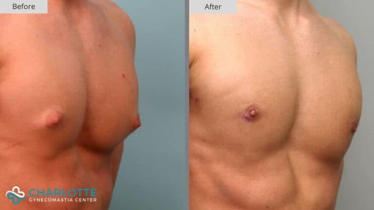 Charlotte Gynecomastia Before and After Patient 124b