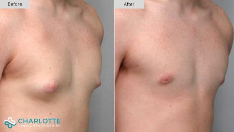Charlotte Gynecomastia Before and After Patient 128a