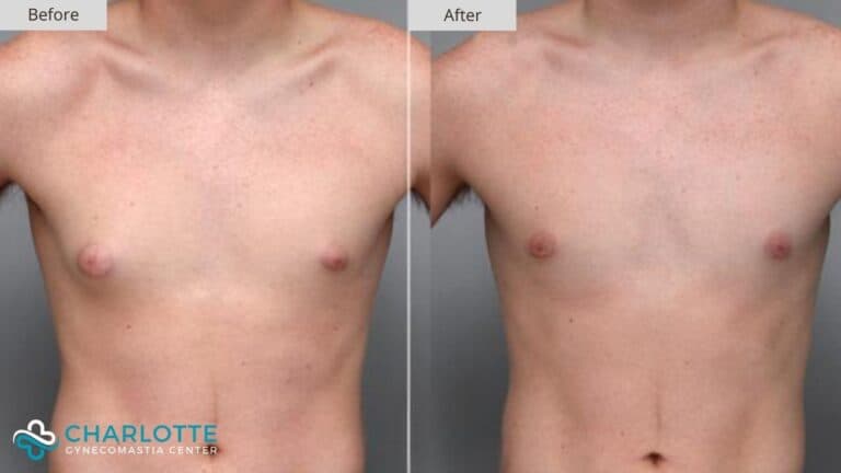 Charlotte Gynecomastia Before and After Patient 128b