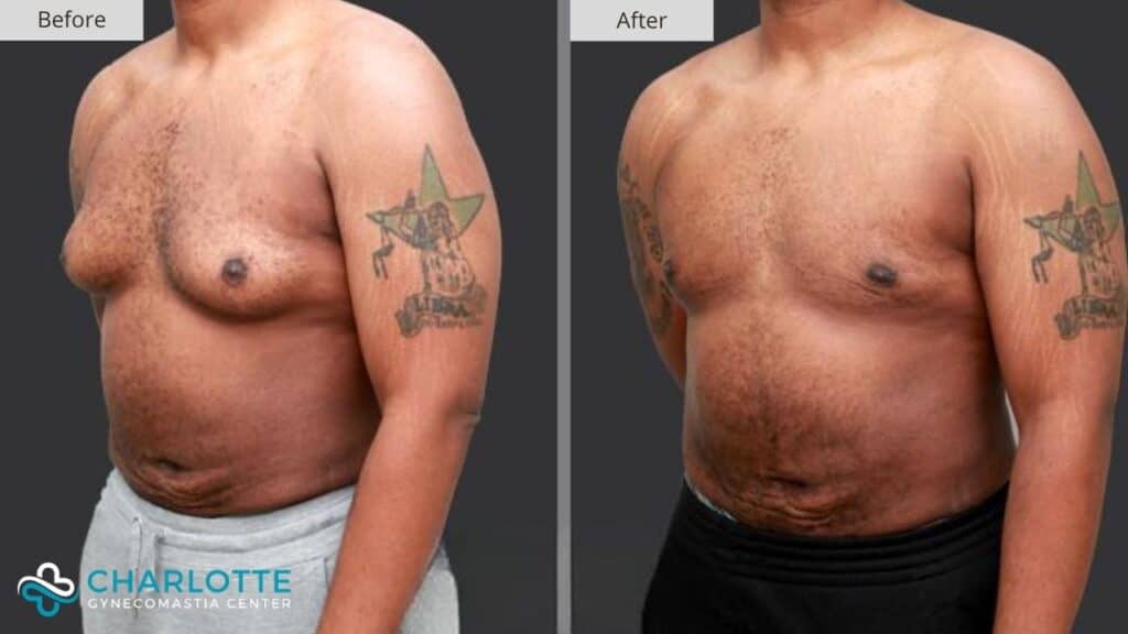 Charlotte Gynecomastia Before and After Patient 130a