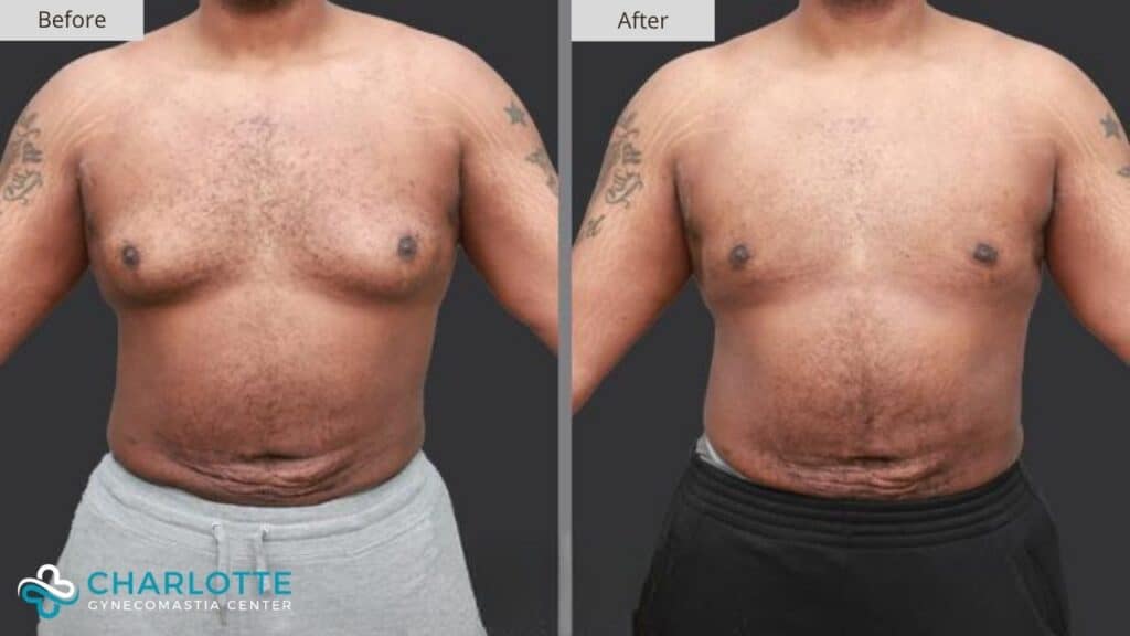 Charlotte Gynecomastia Before and After Patient 130b