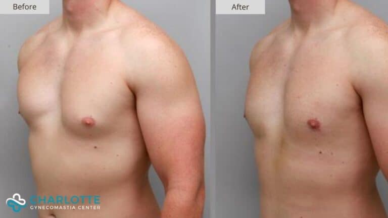 Charlotte Gynecomastia Before and After Patient 134a