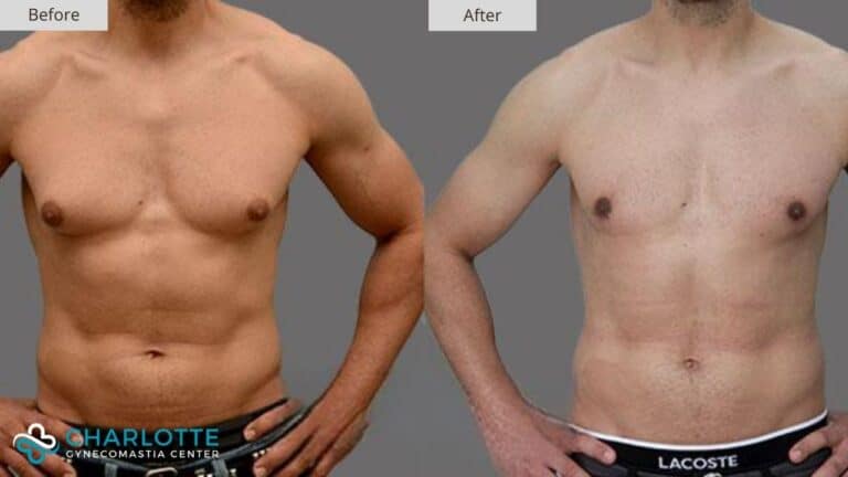 Charlotte Gynecomastia Before and After Patient 134b