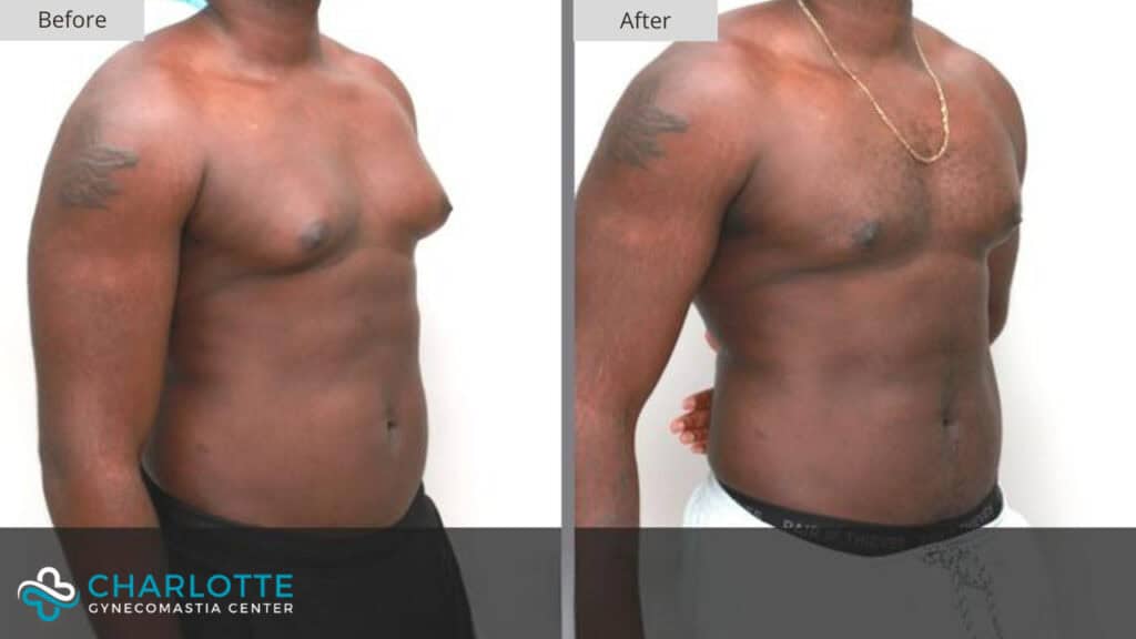 Charlotte Gynecomastia Before and After Patient 134c