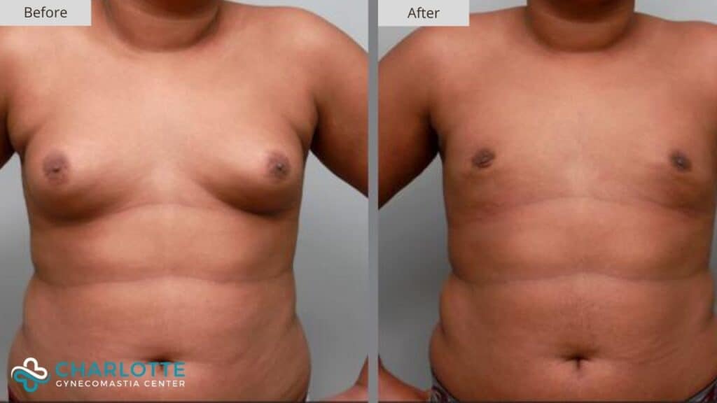 Charlotte Gynecomastia Before and After Patient 136b